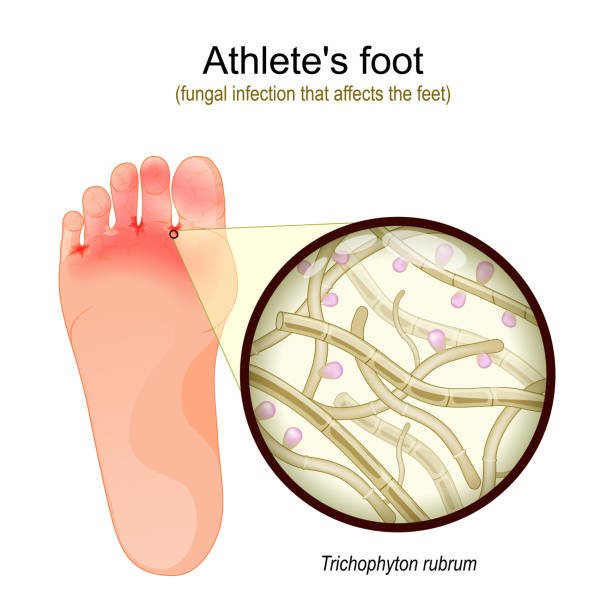 Healthy feet and nails with the best anti-fungus product