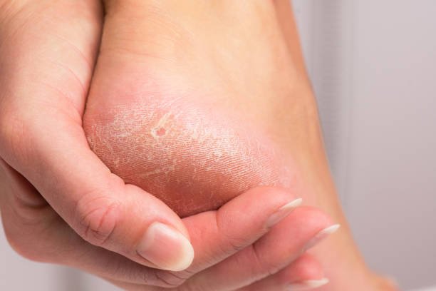 Healthy feet and nails with the best anti-fungus product